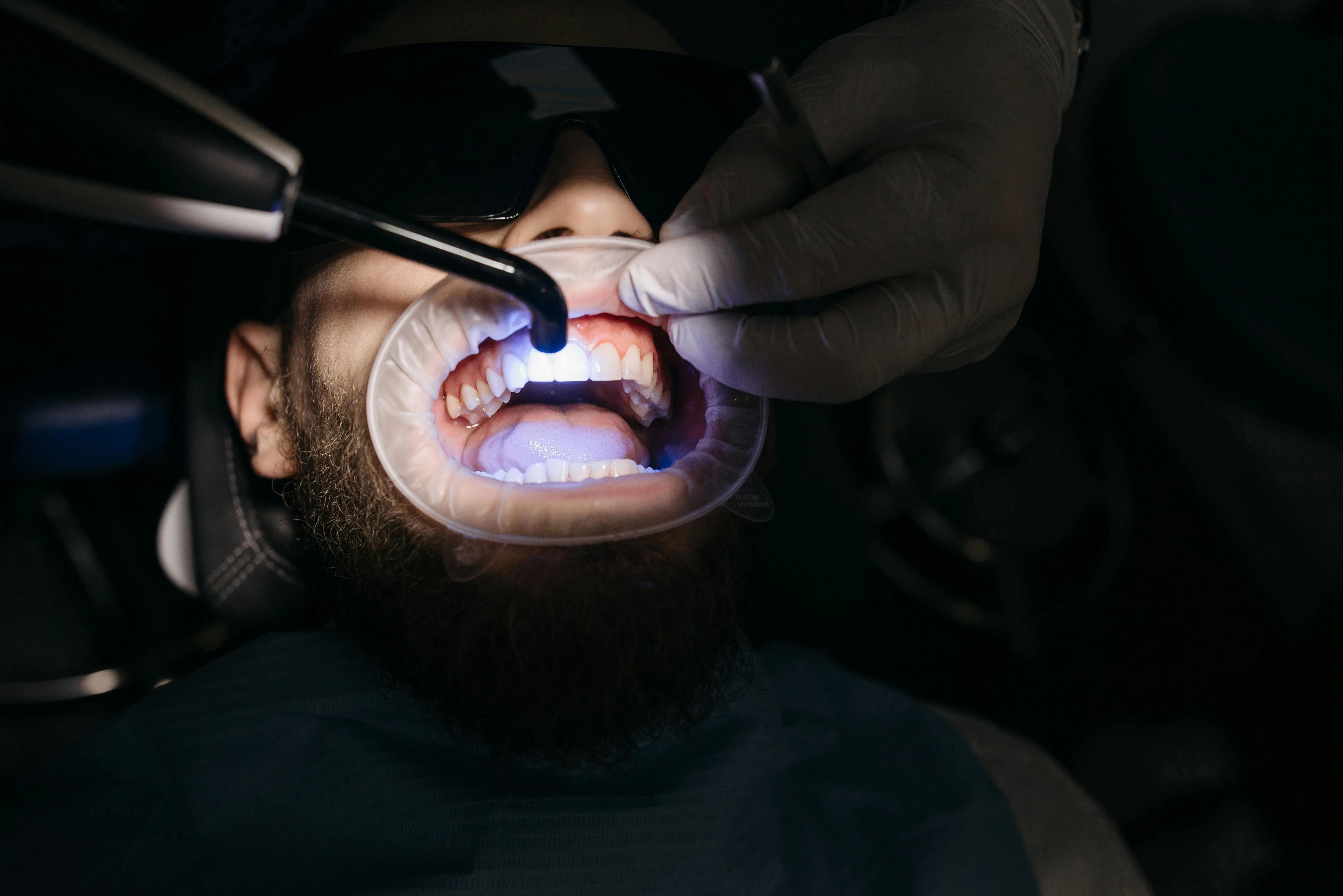 Dental composite resin being applied to tooth surface during bonding